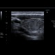 Thyroid nodule: US - Ultrasound